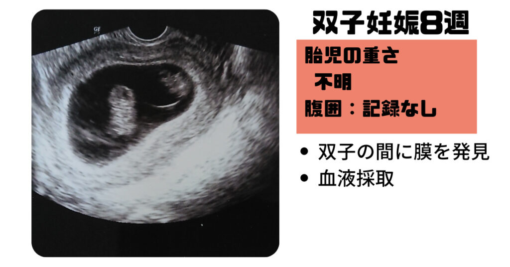 【双子妊娠3ヵ月（8週～11週）】双子妊娠のつわりは個人差あり
